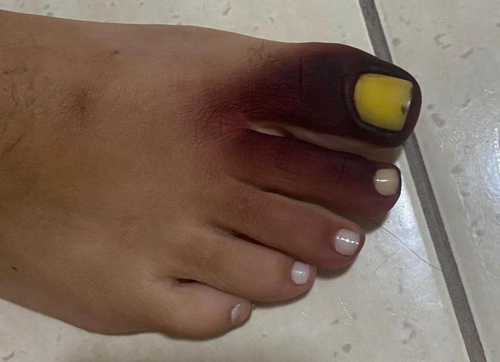 Carioca fica com pé roxo e unha amarela ao calçar tênis com piolho-de-cobra