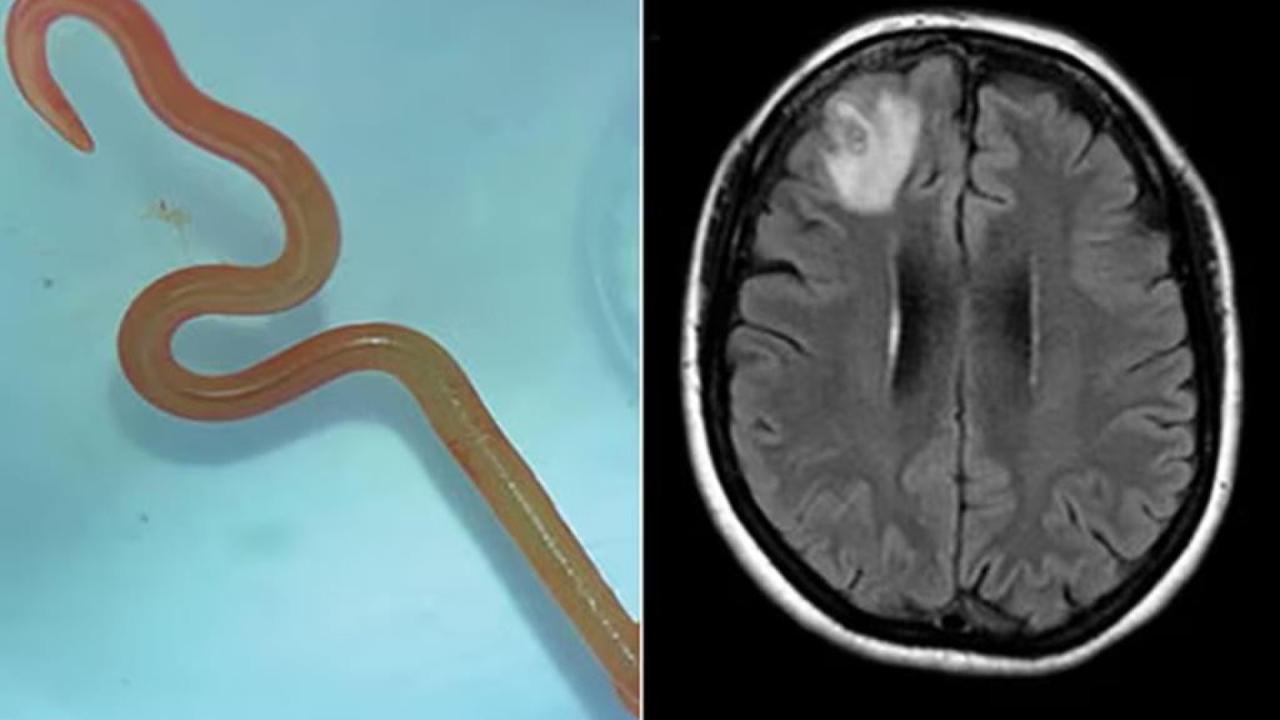 Verme com 8 cm é encontrado em cérebro humano: 
